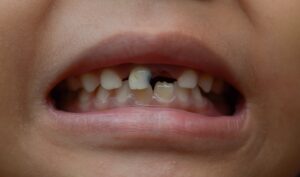 How Trendy Drinks and Supplements Cause Severe Tooth Damage?